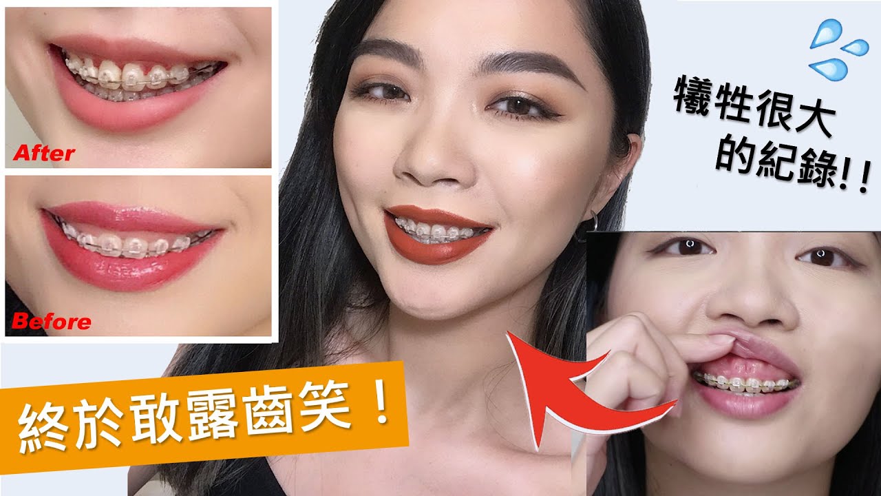牙套更新😖我去開刀了！牙齒終於變大顆！(笑齦、骨爆、牙周翻瓣手術、齒槽骨手術） | tang_ful
