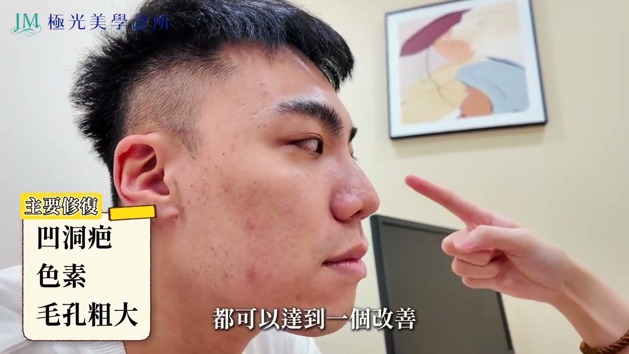 還在煩惱痘疤？醫師推薦組合｜微針+麗珠蘭 實測分享🔥