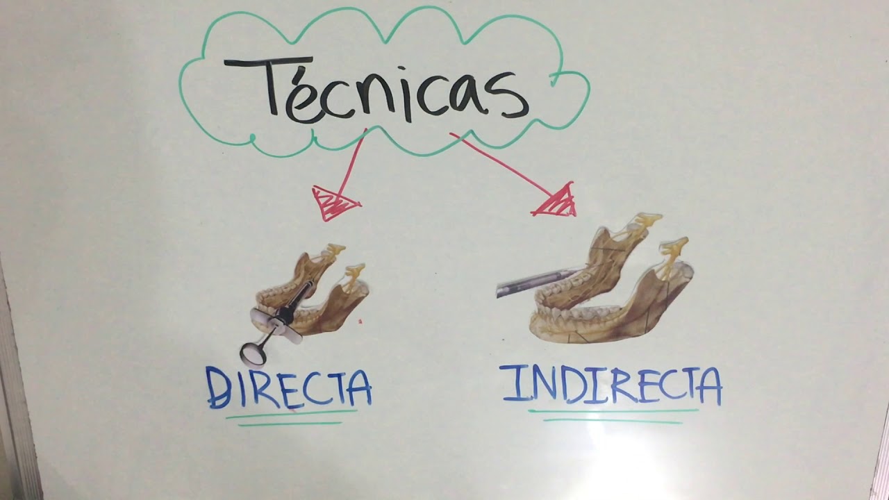 Técnica Troncular Mandibular
