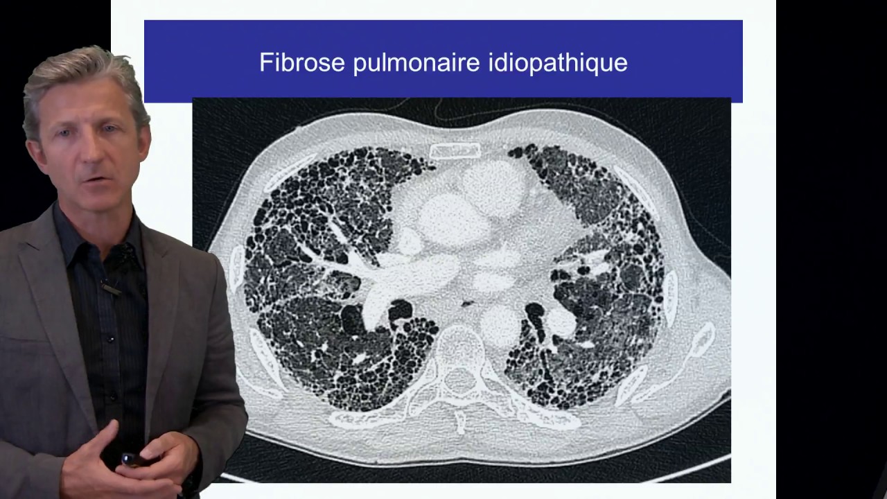 ECN PID cours 2 Fibrose pulmonaire idiopathique DFASM1 Pr V. Cottin Lyon
