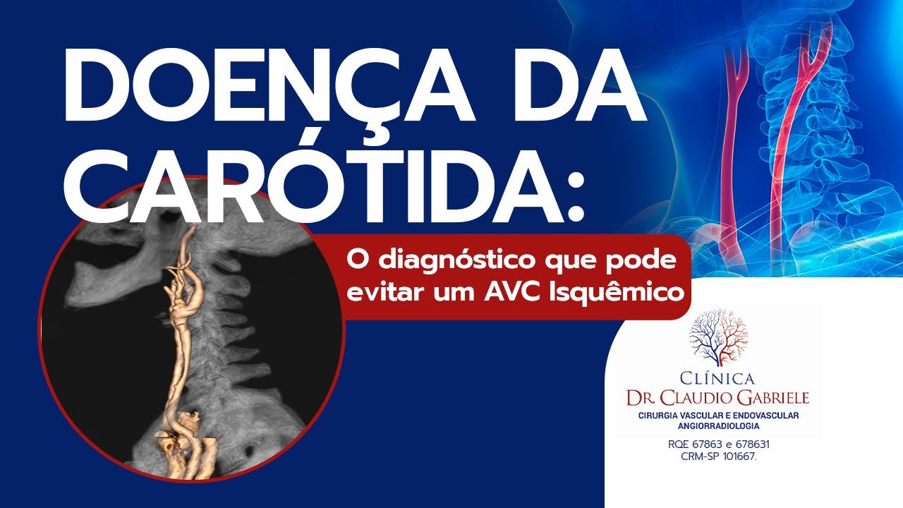 Placa na Carótida: O “Aviso” Silencioso Antes do AVC Isquêmico