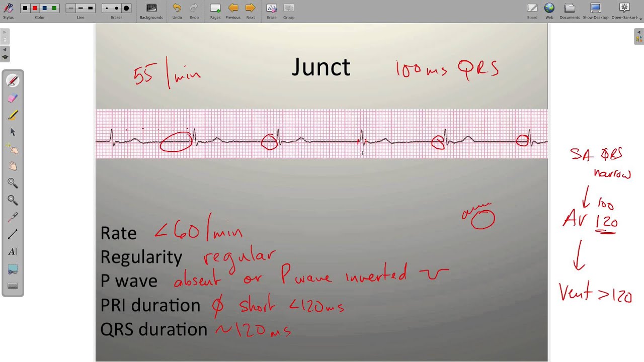 ECG Junctional Rhythms