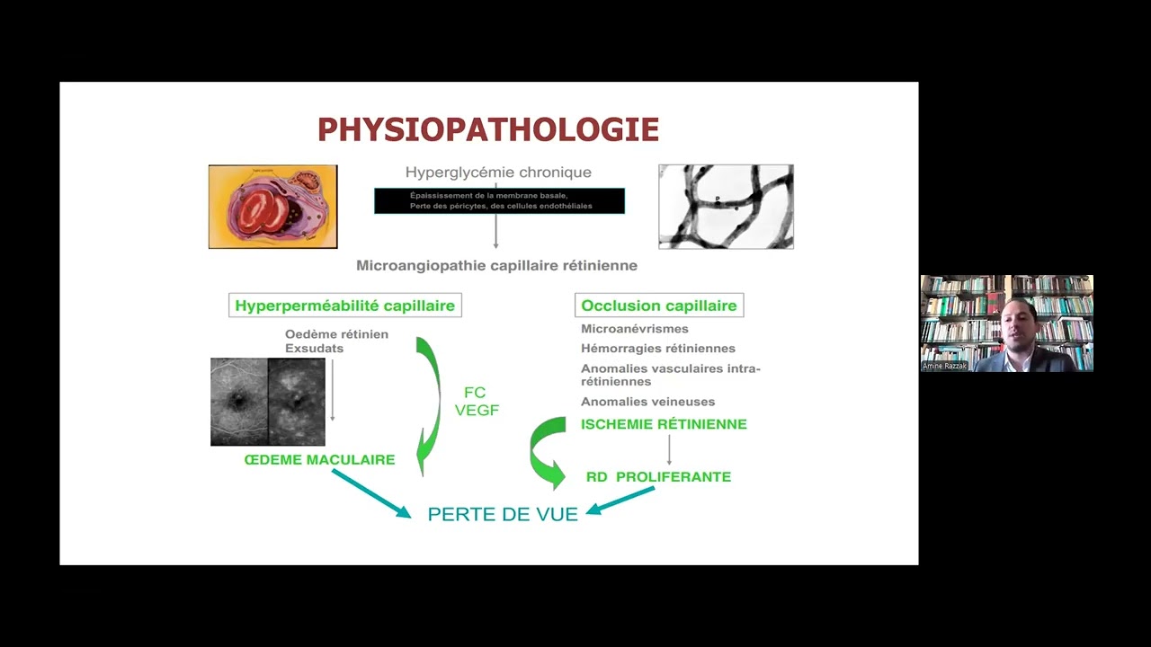 Rétinopathie diabétique