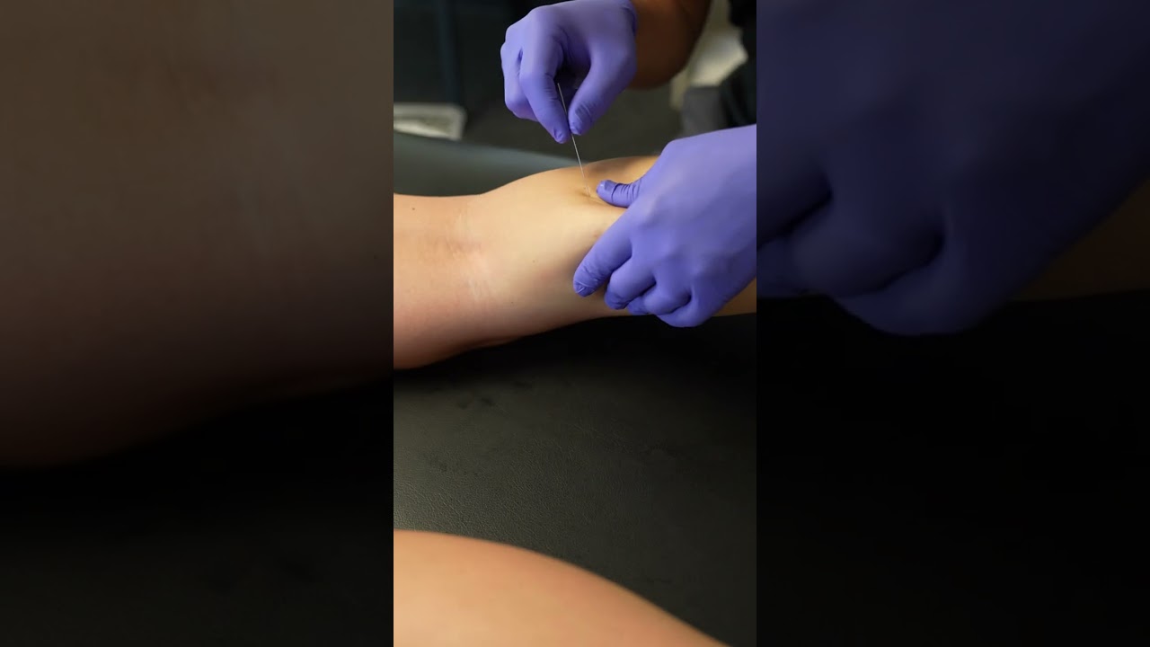 Dry Needling a Runner's Calves