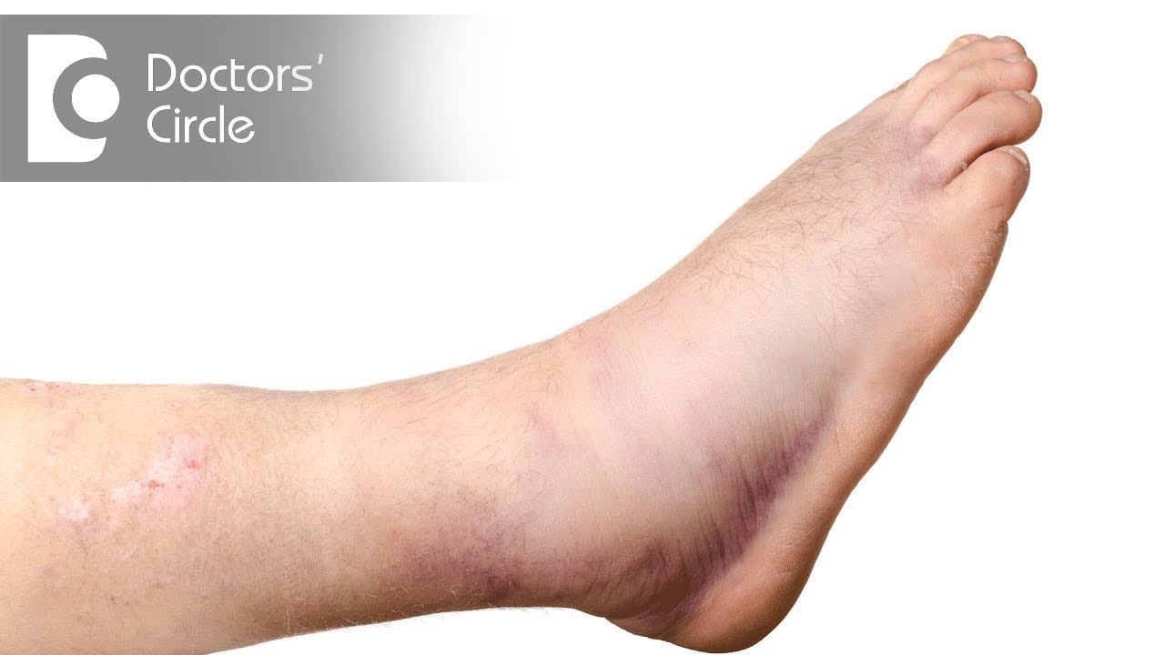 Pain & Swelling after Ankle Surgery : Reasons, Recovery time & Ways to reduce- Dr. Gururaj S Puranik