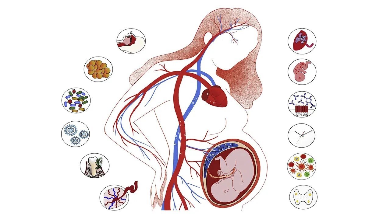 Fisiopatología de la preeclampsia - Dra. Stefania Robles-Trotta