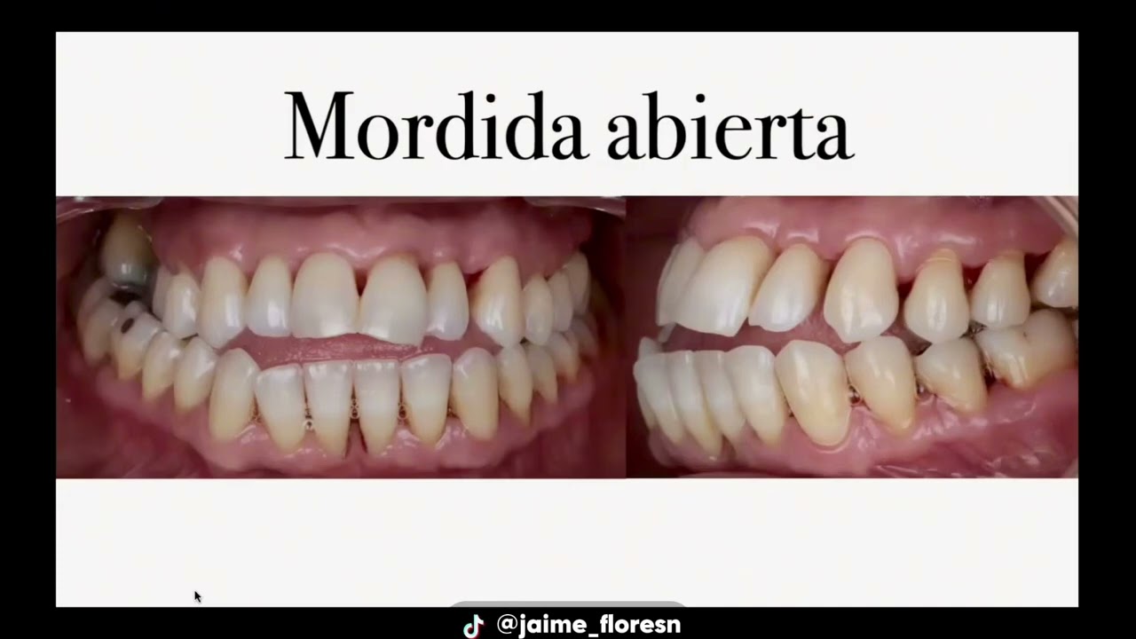 Mordida abierta 