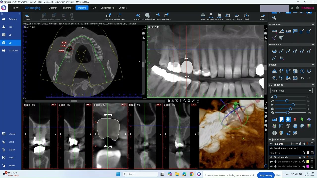 RomexisGenericCrownPlanningImplant