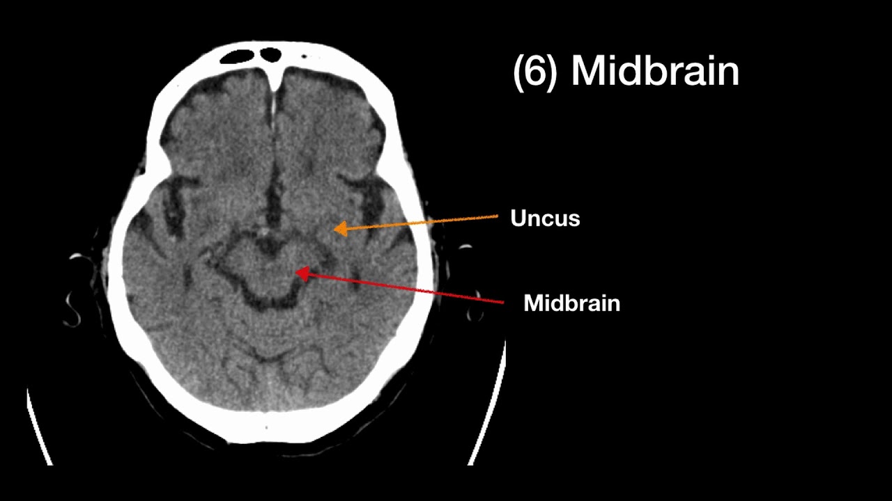 CT brain interpretation in Emergency Practice Part 1