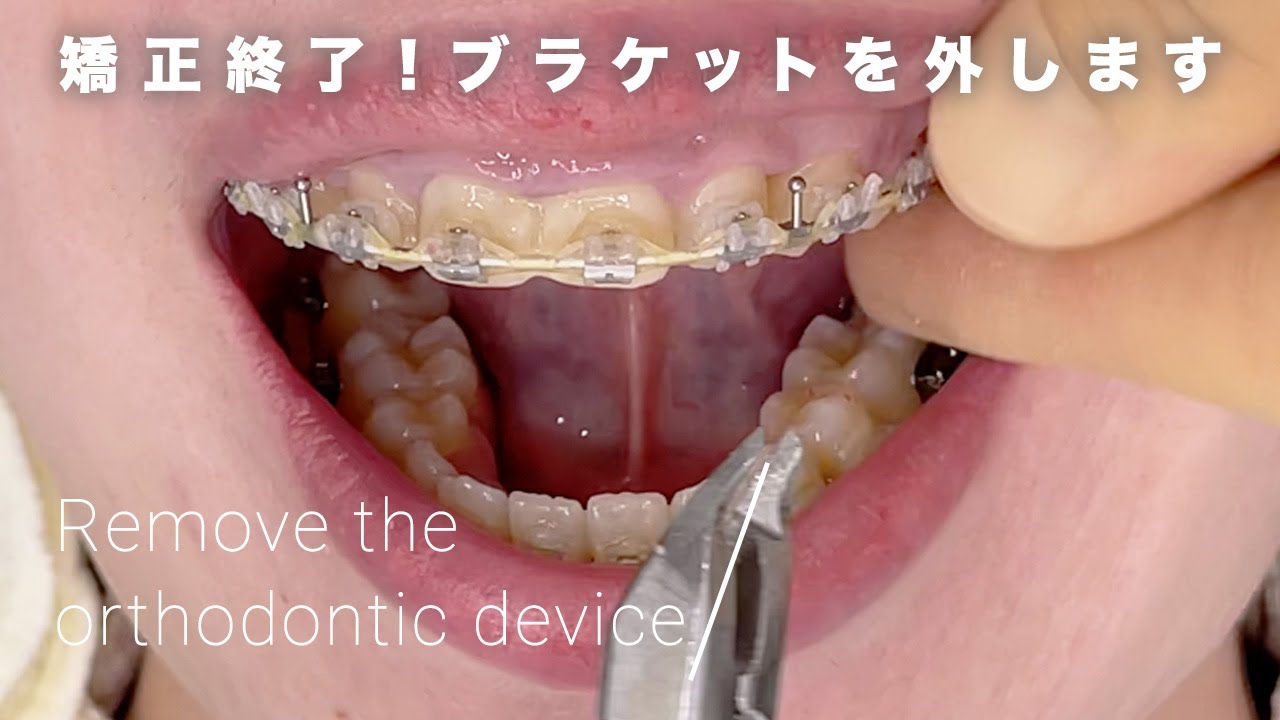 【矯正終了】ついに！ブラケットを外す日の流れお見せします【ブラオフ】
