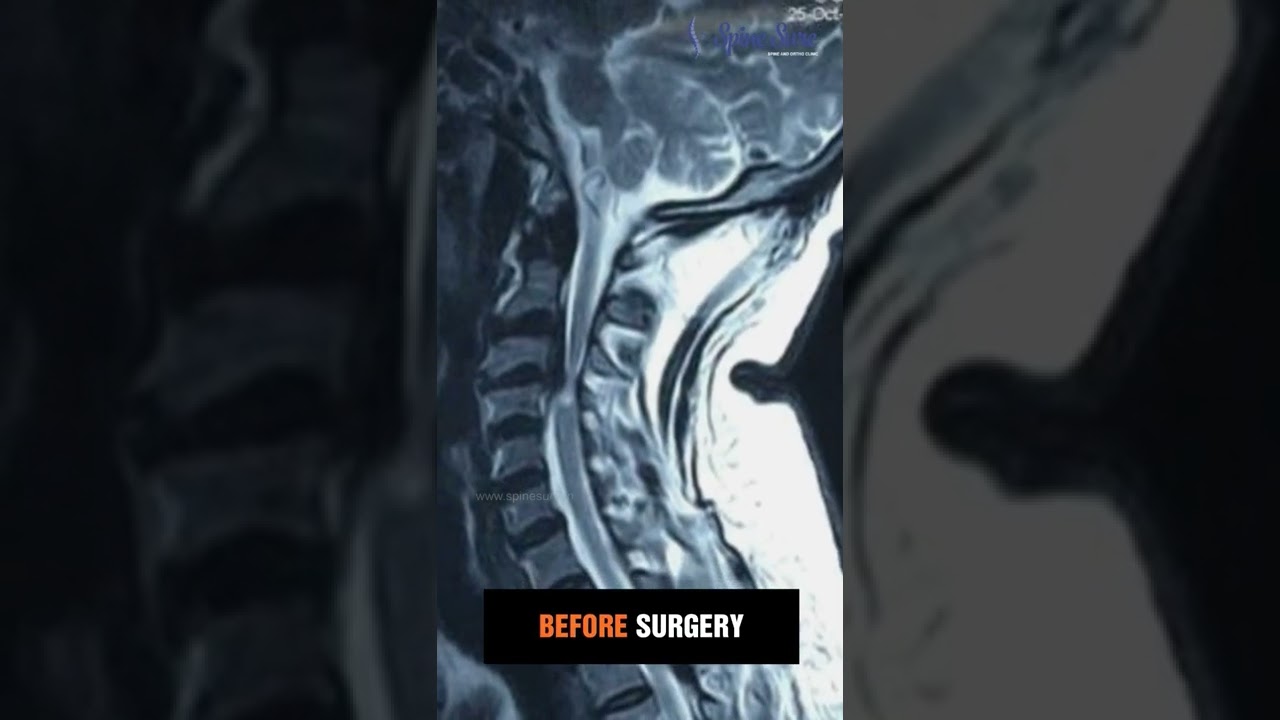 Before and After Spine Surgery 