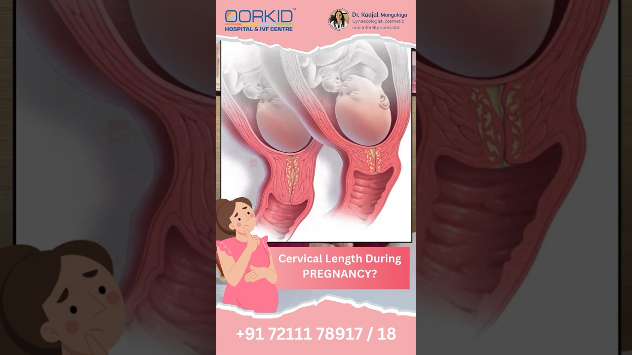 Normal cervical length for normal delivery? Short cervix | Preterm labor | Cervical stitch Gujarat