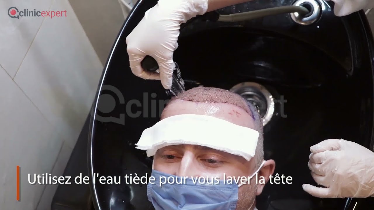 Premier lavage de cheveux après la greffe de cheveux I à Istanbul, Turquie