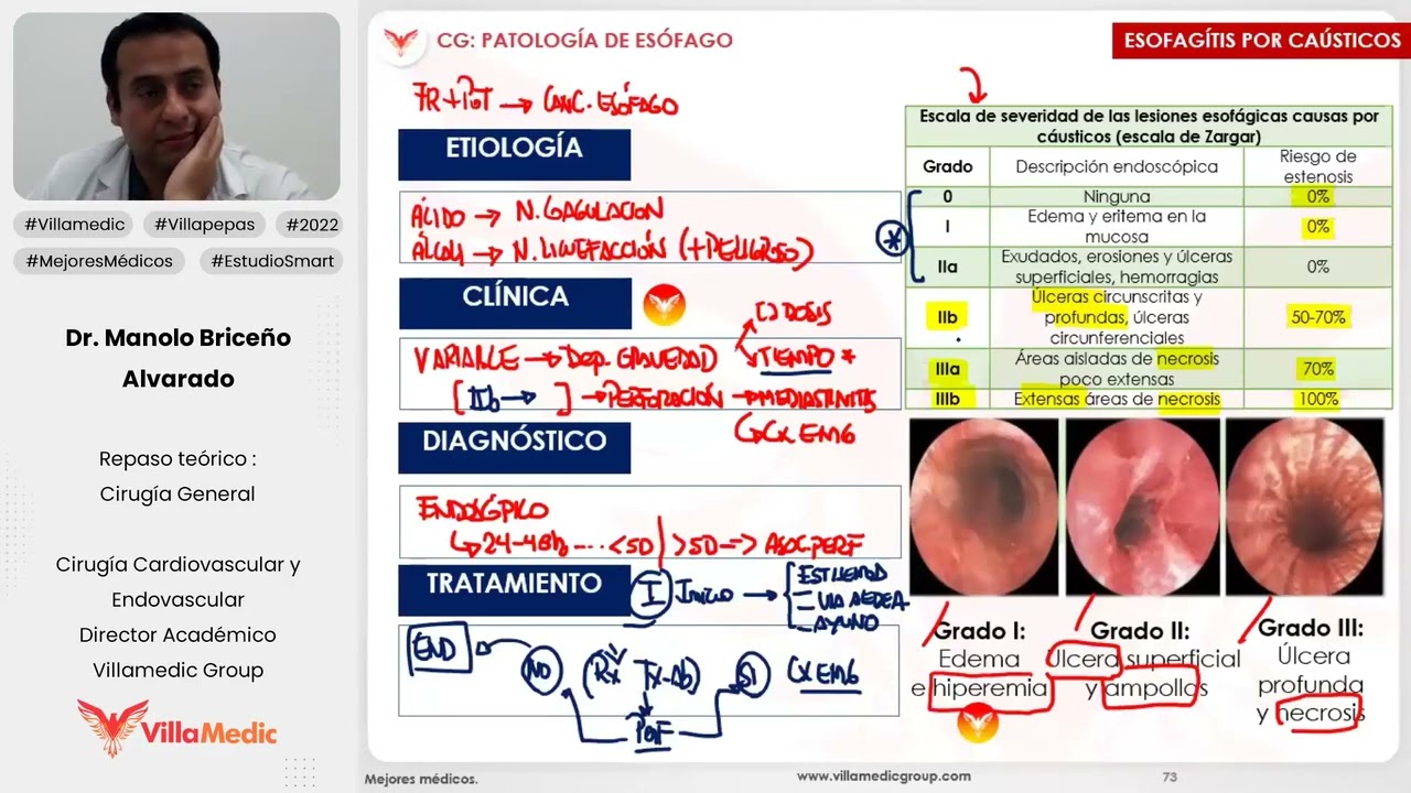 PATOLOGÍA DE ESÓFAGO PARTE 2 - CIRUGÍA GENERAL - VILLAMEDIC