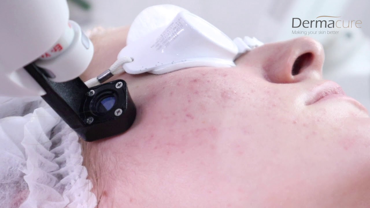 Удаление акне - Harmony XL Pro Laser - чистая кожа