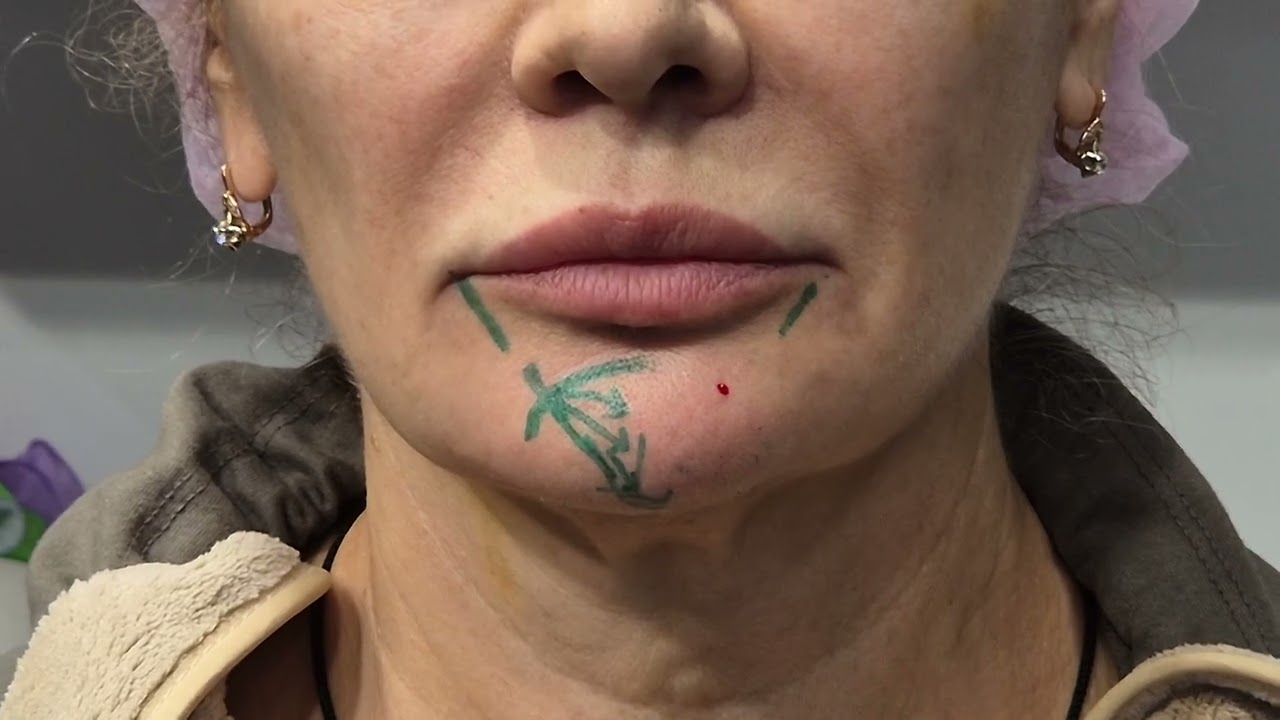 Работа с ассиметрией, воолюмизация,качество кожи. Канюля , игла. 