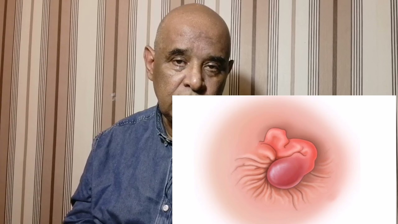 ኦሞረይድዮ - Hemorrhoids