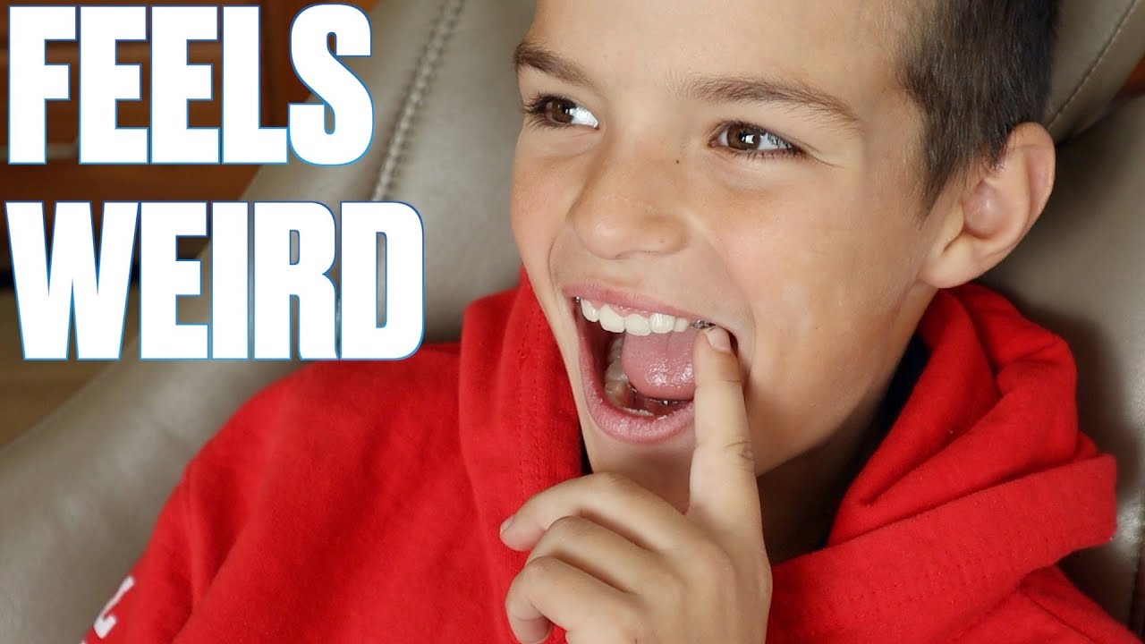 FIRST TIME GETTING BRACES UPDATE | PAINFUL SPACERS REMOVED | GETTING READY FOR EXPANDER