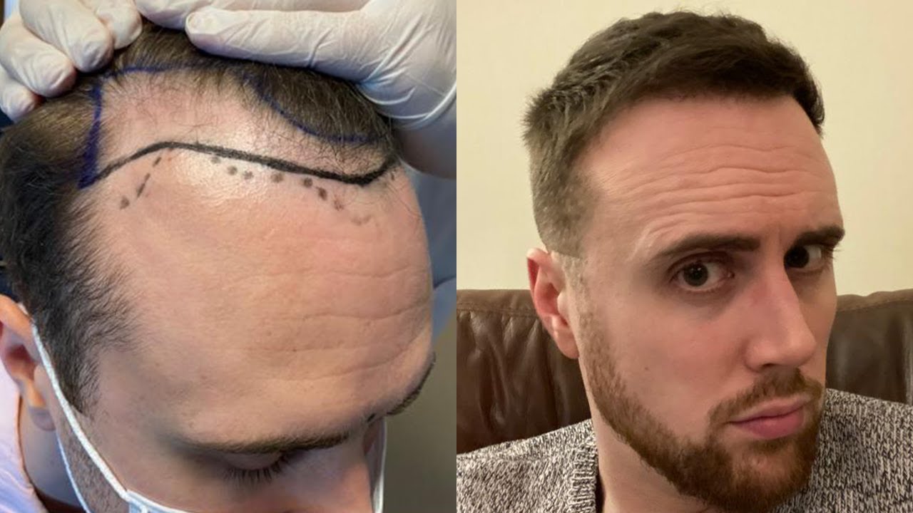 Martin's Entire Hair Transplant Surgery + the Process in Turkey (Beginning to End)