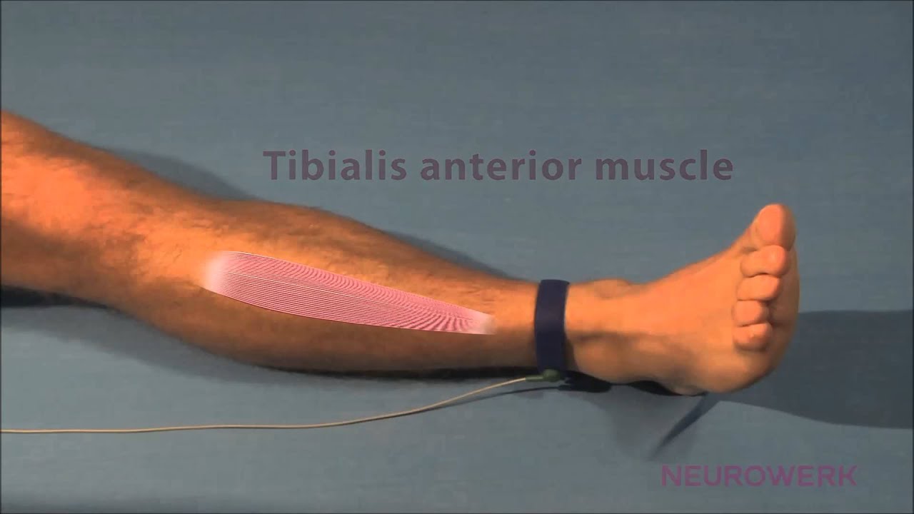 Needle EMG