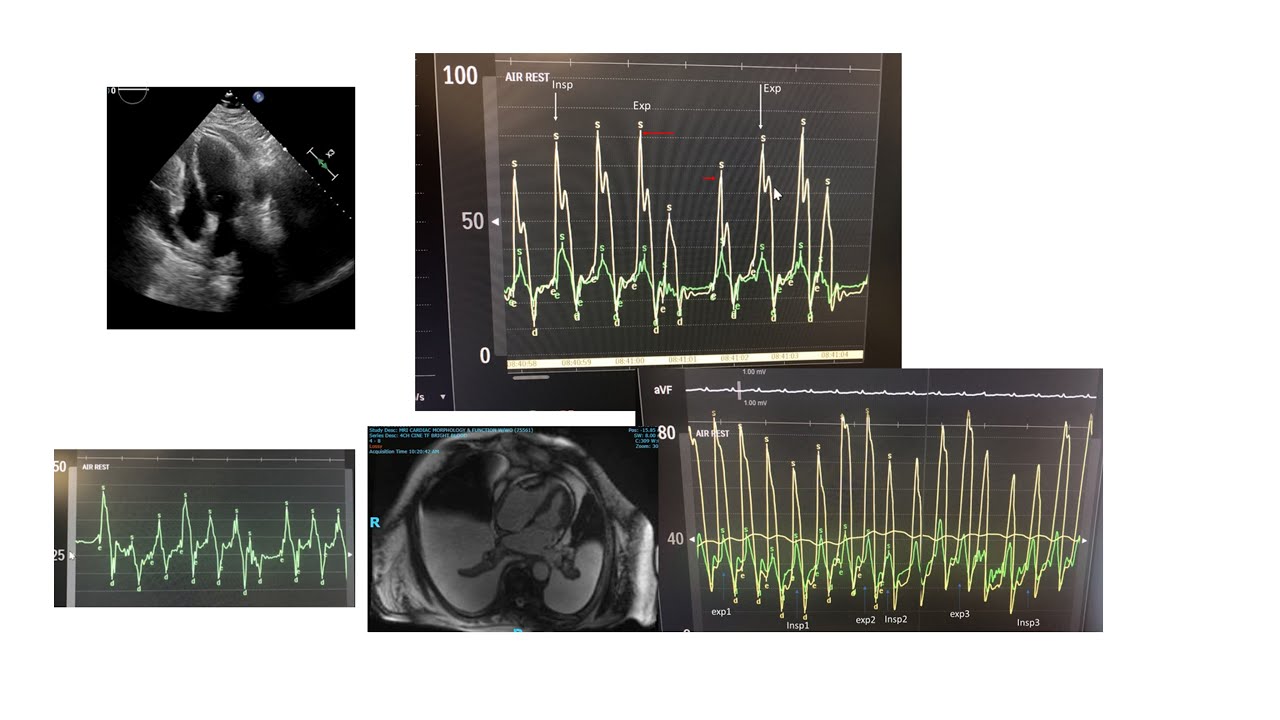 A hemodynamic journey: HFpEF, constriction, afterload. What is afterload? Elias Hanna