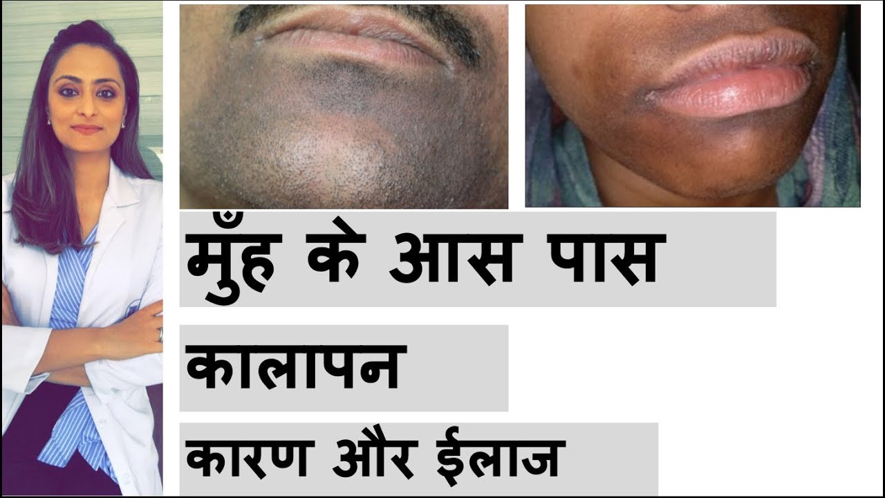मुँह के आस पास कालापन | कारण | इलाज | darkness around mouth | home remedies| dermatologist