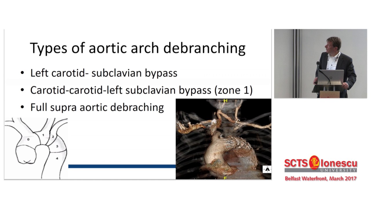 Endovascular repair of the aortic arch
