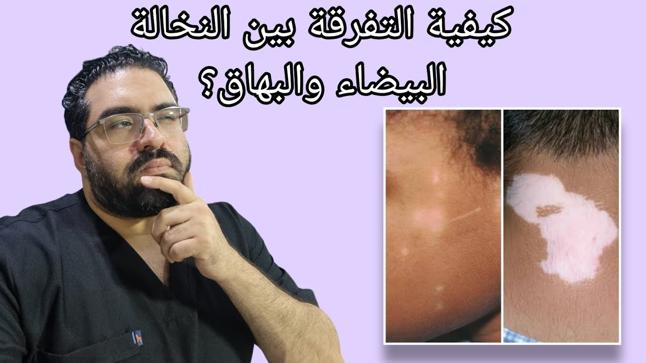 عيادة الجلدية - حلقة ٤ -  نخالة البيضاء ولا بهاق؟