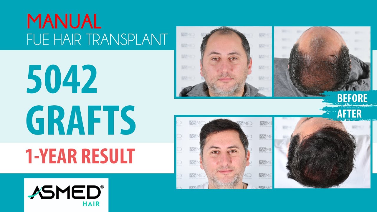 Manual FUE Saç Ekimi 5042 Greft 1 Yıllık Sonuç #hairtransplant #saçekimi