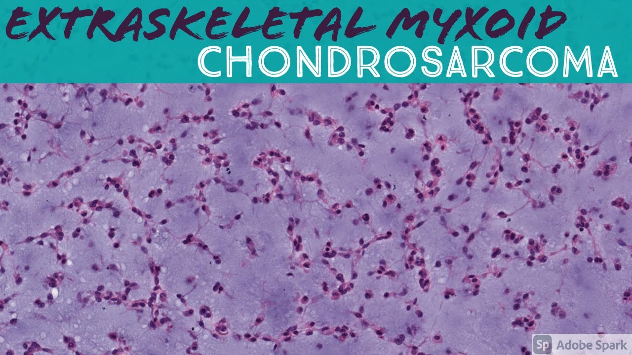 Extraskeletal Myxoid Chondrosarcoma: 5-Minute Pathology Pearls