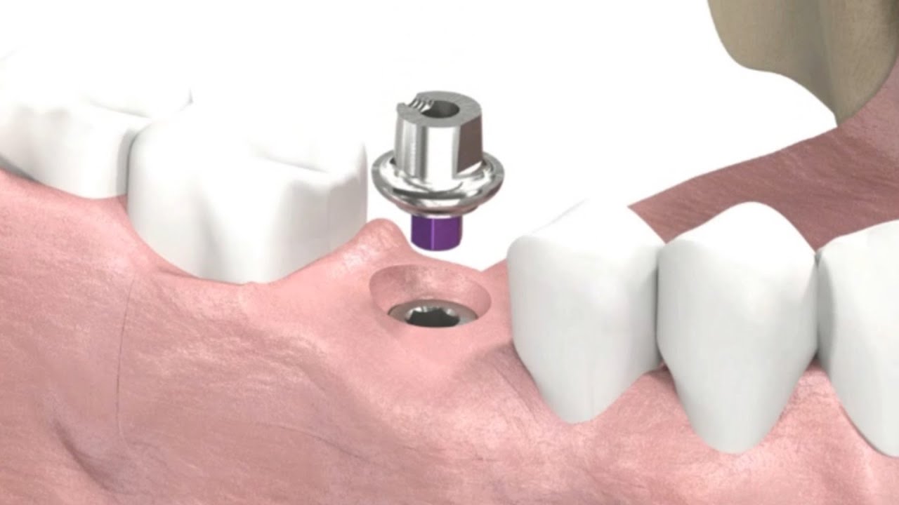 SIC invent  Dental Implant  - Prosthetic Animation: Single Crown (Closed Tray Technique)