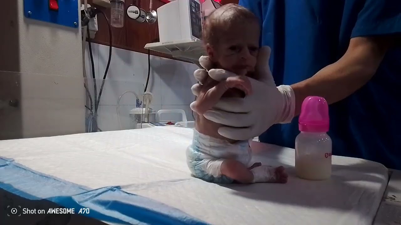 Supporting Growth: Bottle Feeding in PCM Babies