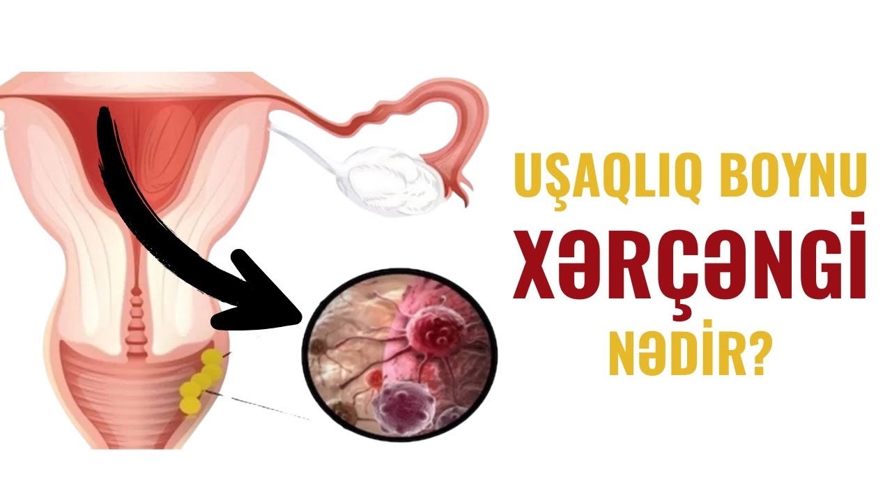 Uşaqlıq boynu xərçənginin əlamətləri və erkən aşkarlanması