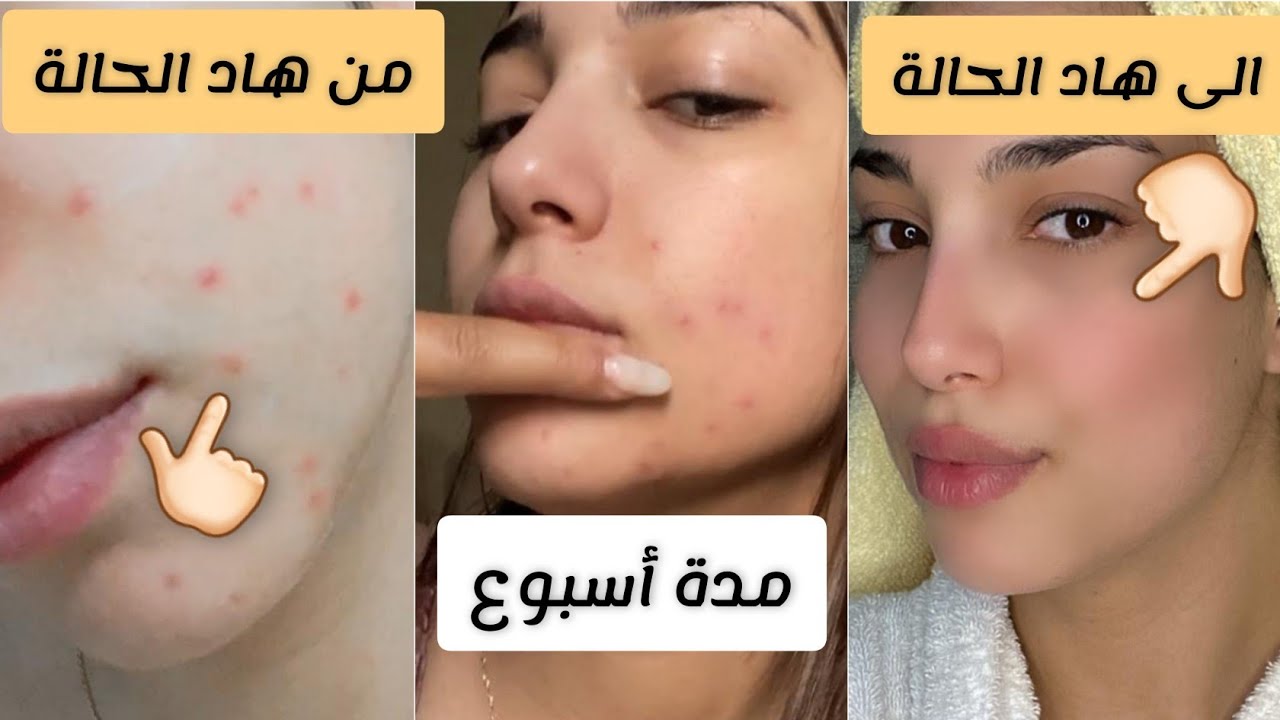 تجربتي مع الحبوب في الوجه😱كيفاش تخلصت منها فمدة أسبوع بدون آثار😲بمنتجات رخيصة فكل بيت🏠