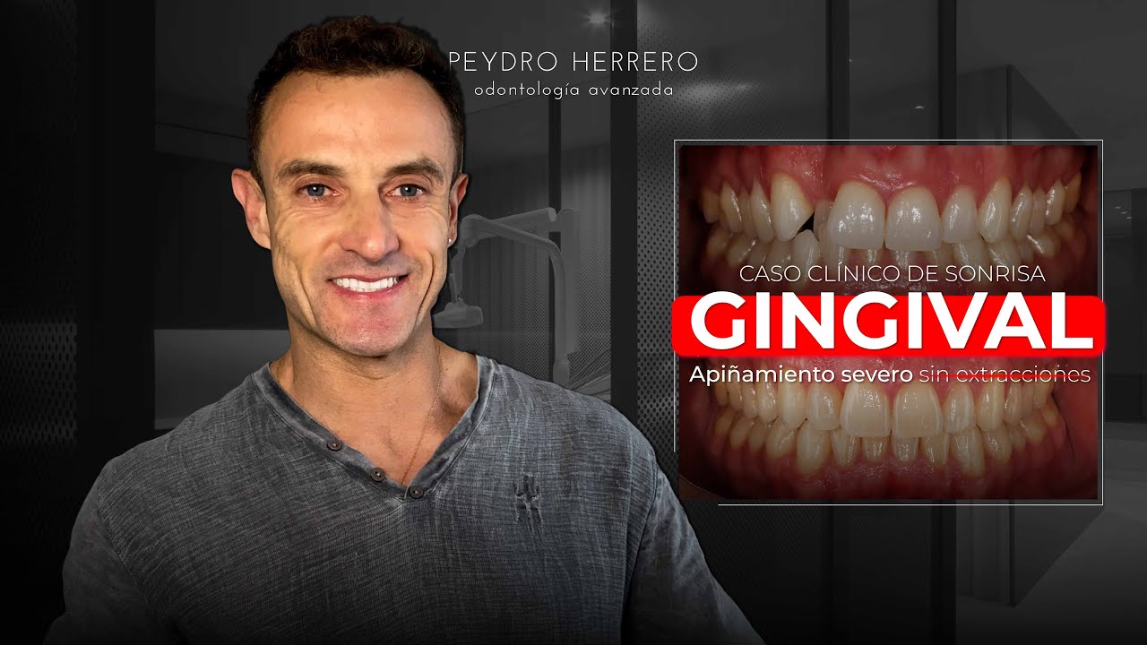 ❌ Así solucionamos la Sonrisa GINGIVAL y APIÑAMIENTO SEVERO - Clínica Peydro