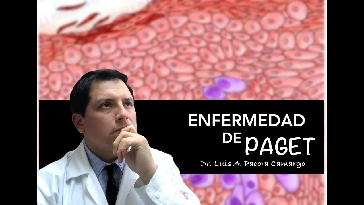ENFERMEDAD DE PAGET ❗El CÁNCER ⚠️ de PEZÓN 😱