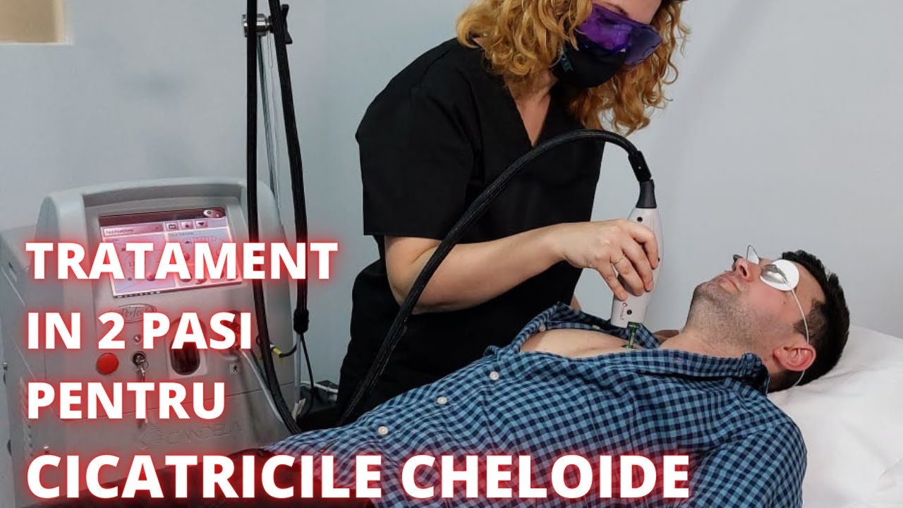 Tratamentul Cicatricilor Cheloide cu Laserul Vascular PDL Vbeam | DermaBeauty Clinique
