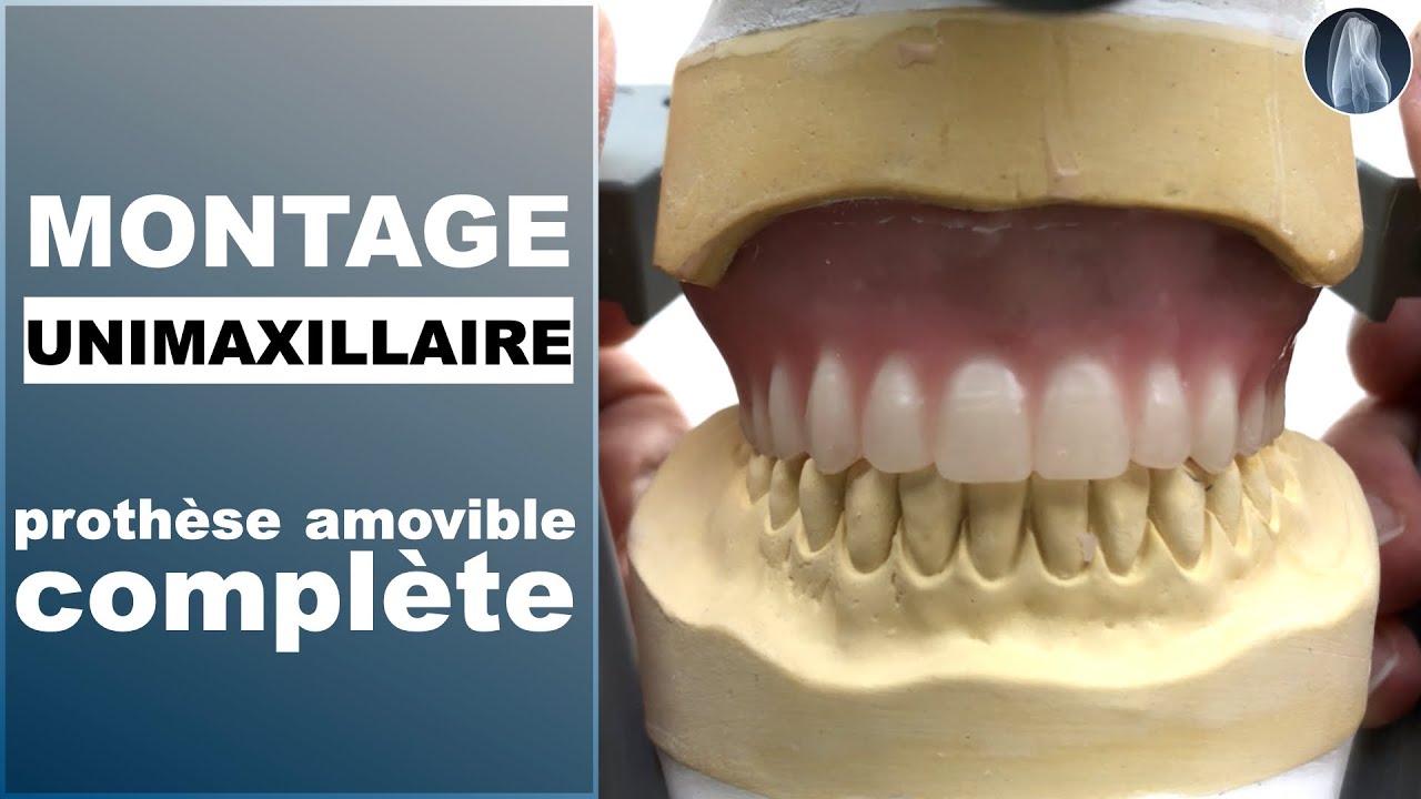 Concevoir une Prothèse Amovible Complète Unimaxillaire : Étapes Clés et Techniques Professionnelles