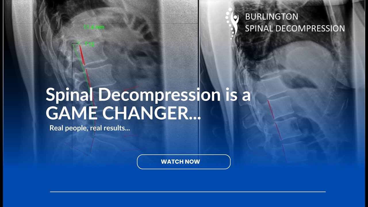 Spinal Decompression is a GAME CHANGER...