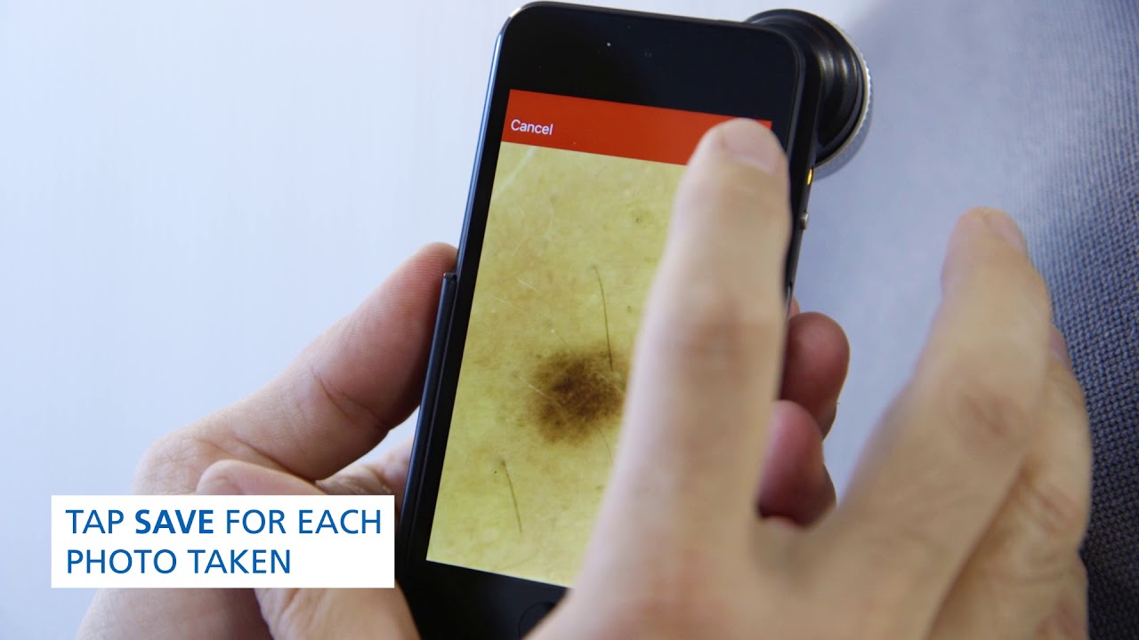Using the FotoFinder Handyscope