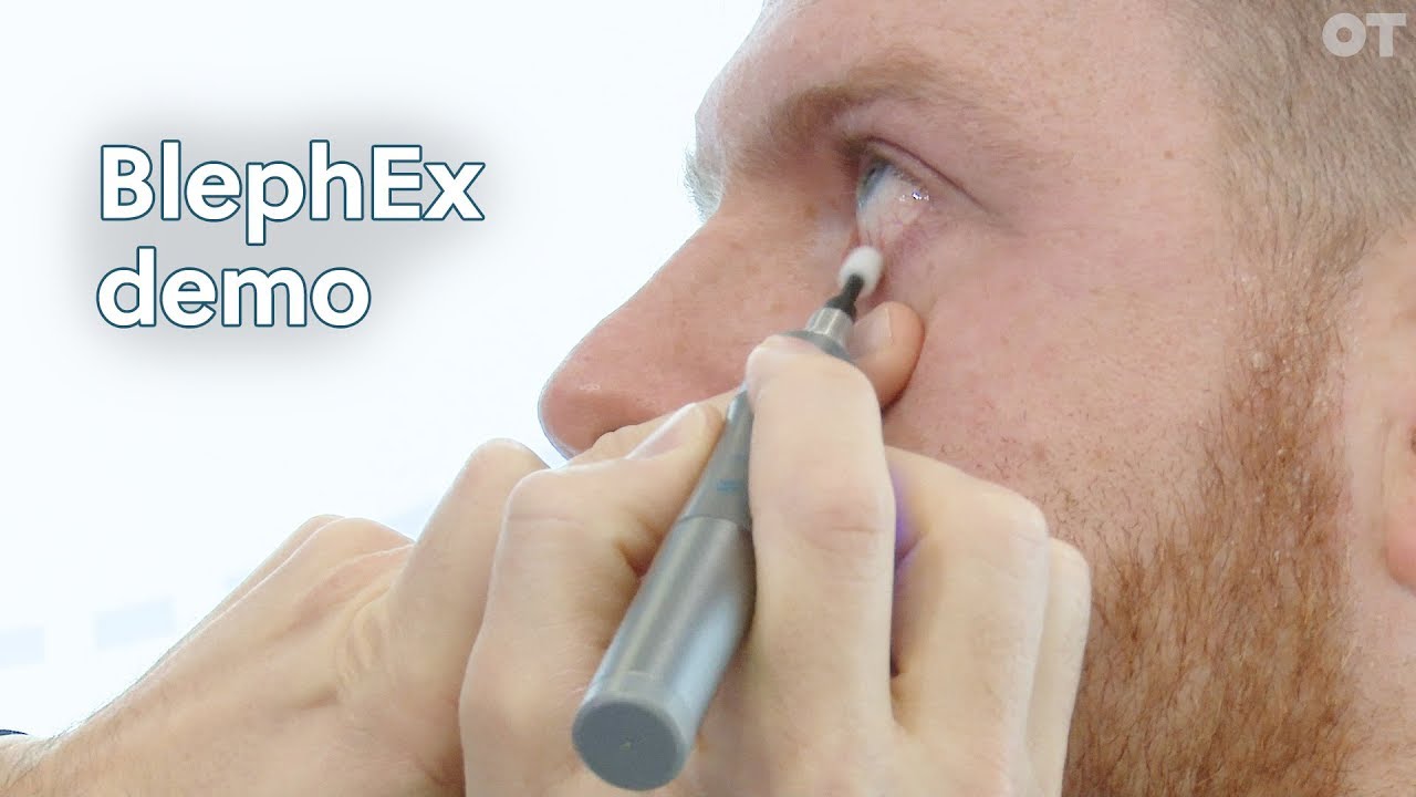 Scope Ophthalmics speaks to OT about its BlephEx tool for treating blepharitis