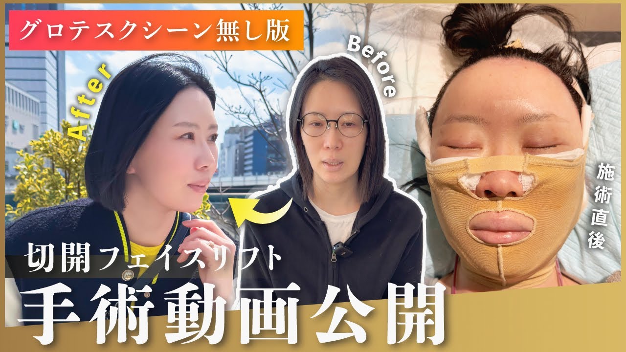 【グロテスクシーンカット版】驚きの結果⁉︎フェイスリフトの全顔美容整形モニター密着取材！チャンネル初の手術映像も大公開！【切開フェイスリフト/脂肪移植】#ZetithBeautyClinic #王蘇