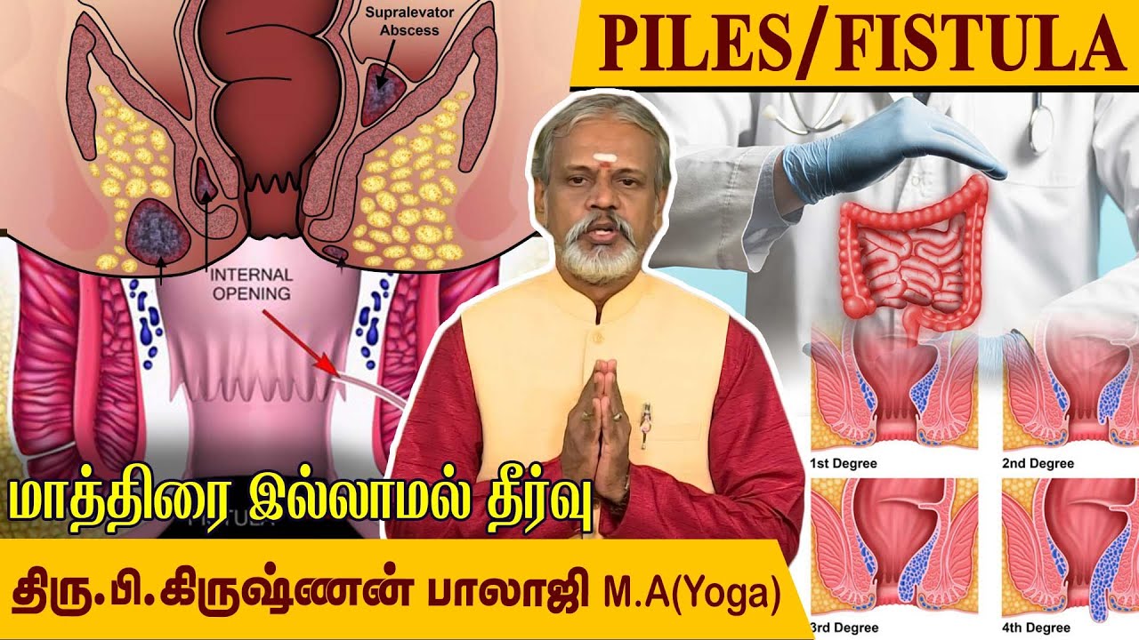 Piles, Fistula / உள் மூலம், வெளி மூலம். மாத்திரை இல்லாமல் தீர்வு. l Krishnan Balaji @megatvindia
