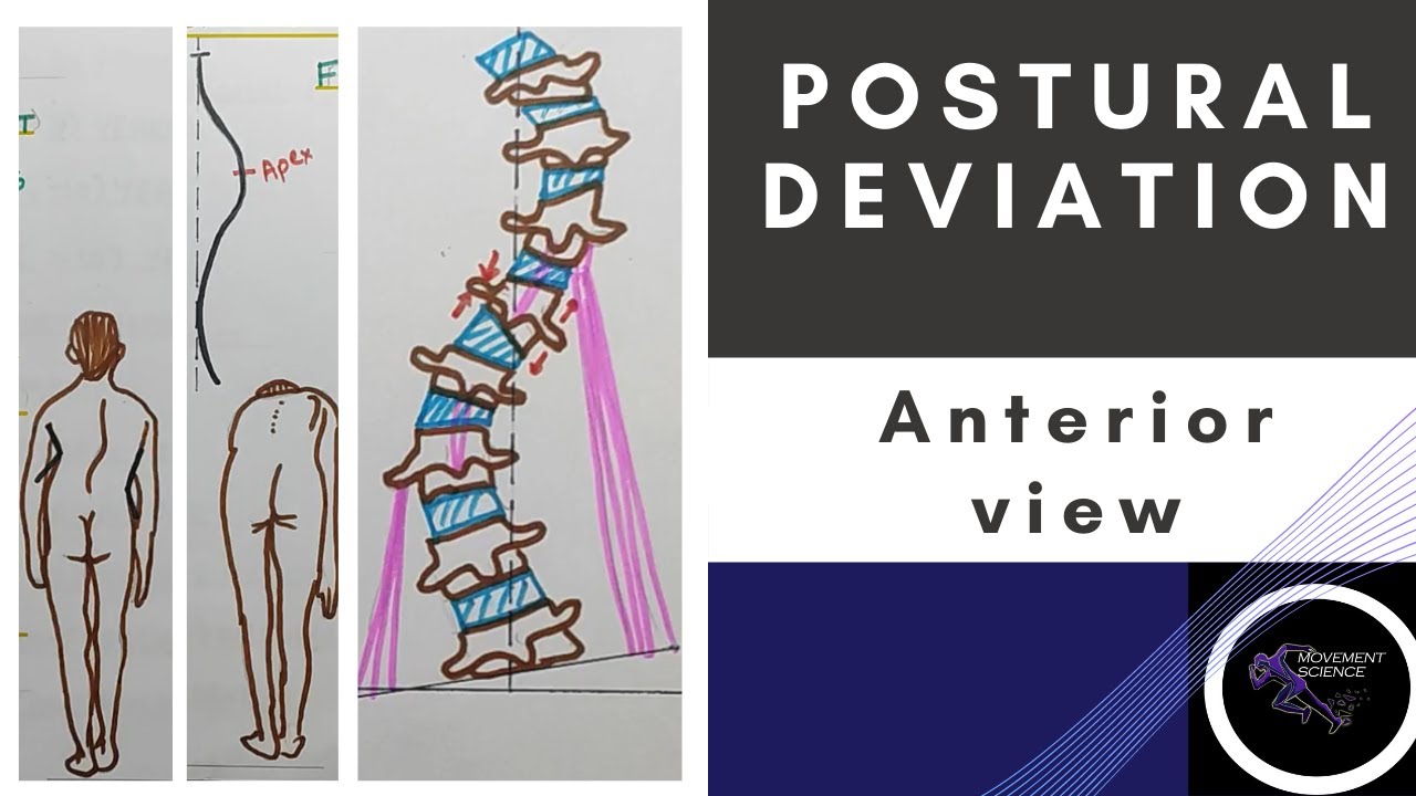 POSTURAL DEVIATION IN FRONTAL PLANE- SCOLIOSIS  (Posture Biomechanics)Physiotherapy Tutorial