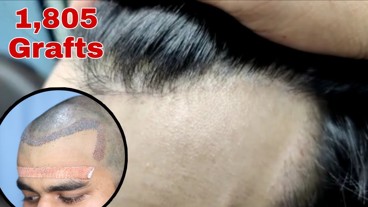 Hairline Hair Transplant || Receding Hairline || NW Grade II || 1,805 Grafts ||  @Regrow Clinic ​