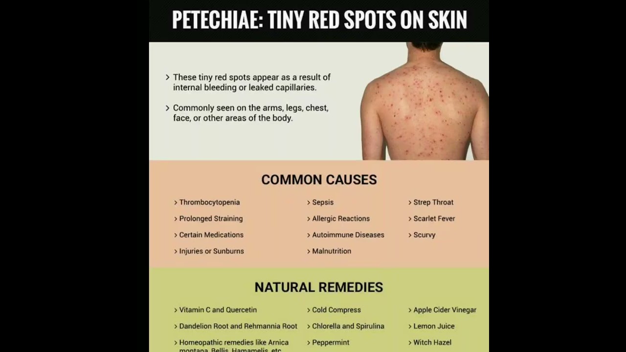 Petechiae causes  #doctor #shortsfeed #short
