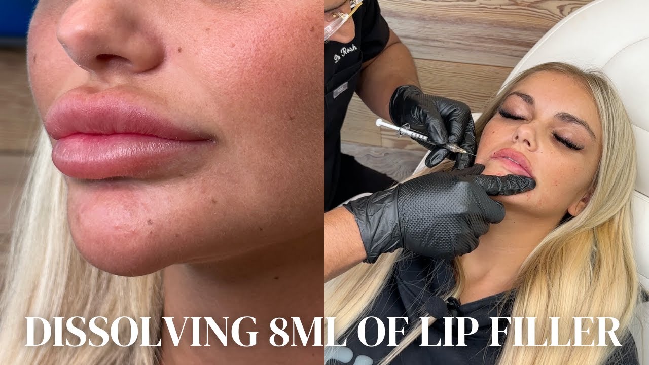 Dissolving 8ml of Lip Filler! Insane Results