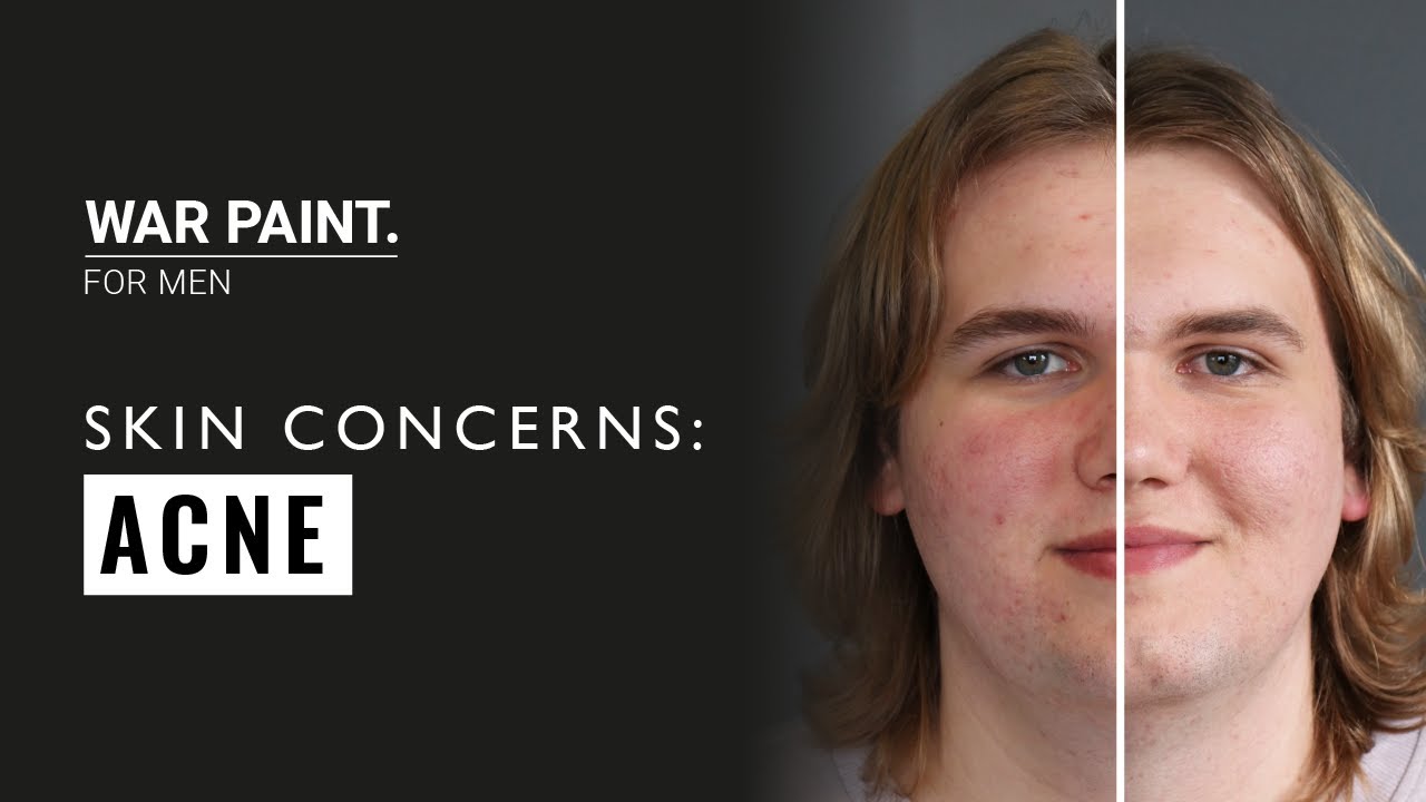 TACKLING COMMON SKIN CONCERNS | ACNE