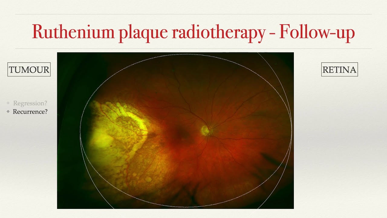 Radiation Side Effects on the Retina, including Radiation Maculopathy (UK)