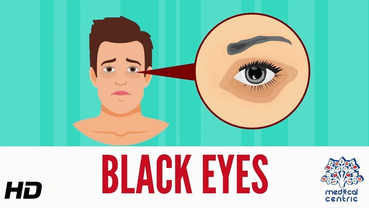Black Eye, Causes, Signs and Symptoms, Diagnosis and Treatment